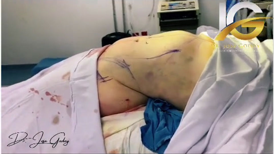 Lipoescultura+Abdominoplastia